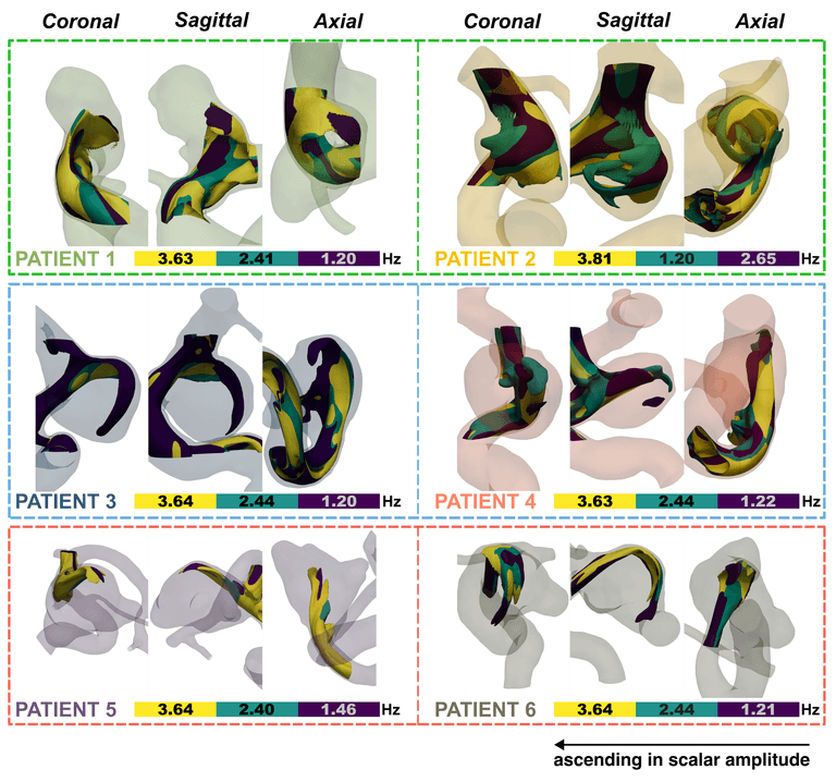 Modal analysis of blood flows in saccular aneurysms